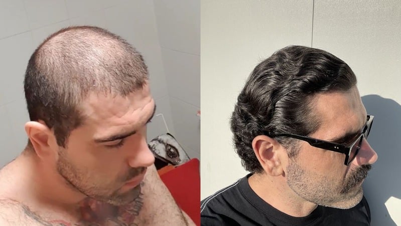 My hair recovery - before and after